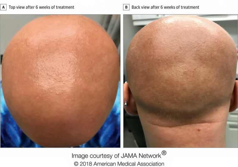 Illustration for article titled Un efecto secundario en un nuevo fármaco contra la dermatitis devuelve el pelo a una paciente con alopecia